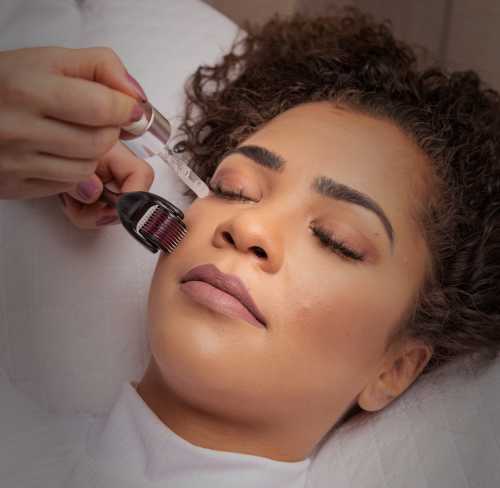 Microneedling